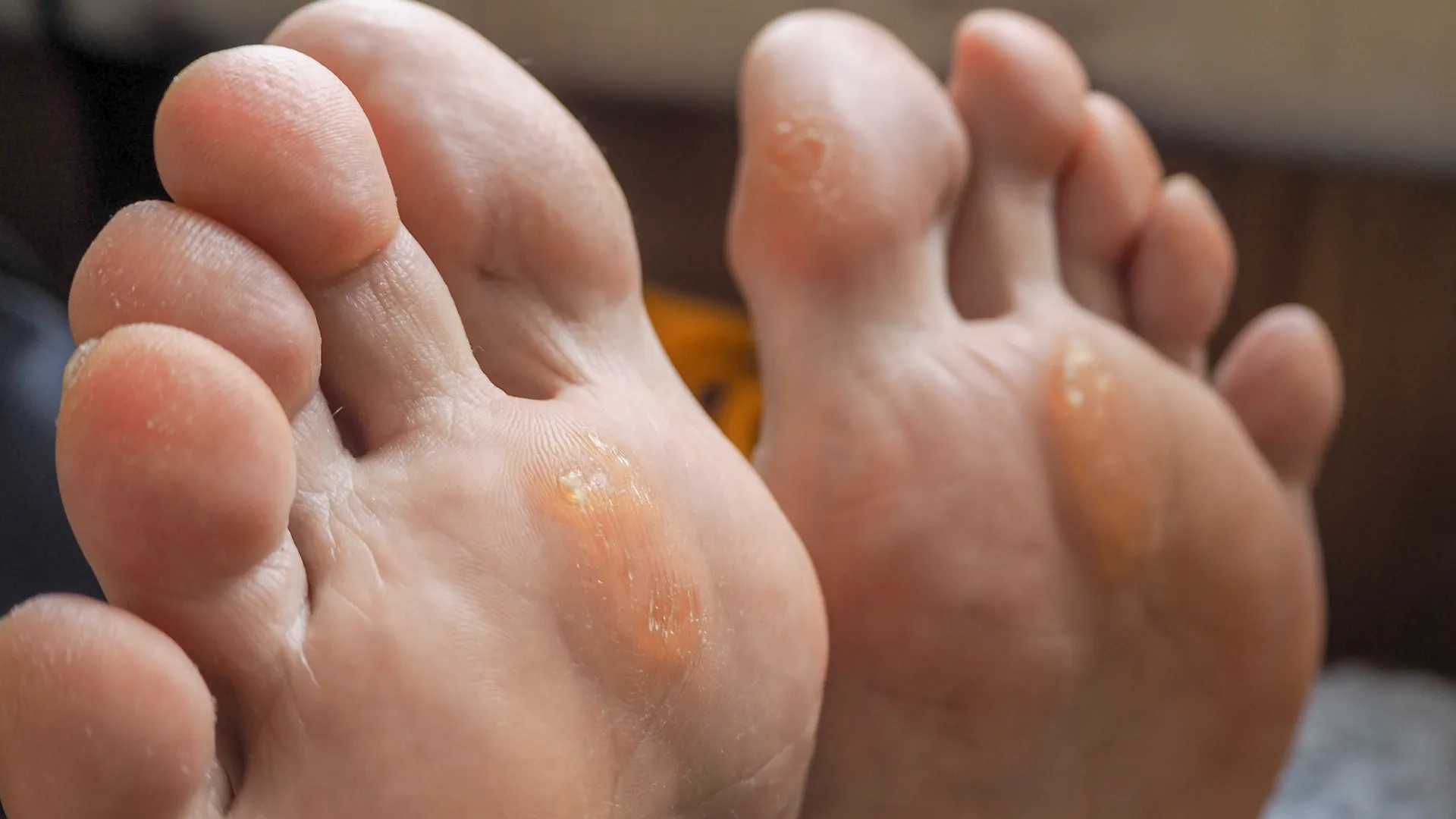 dermafeet-tipos-hongos