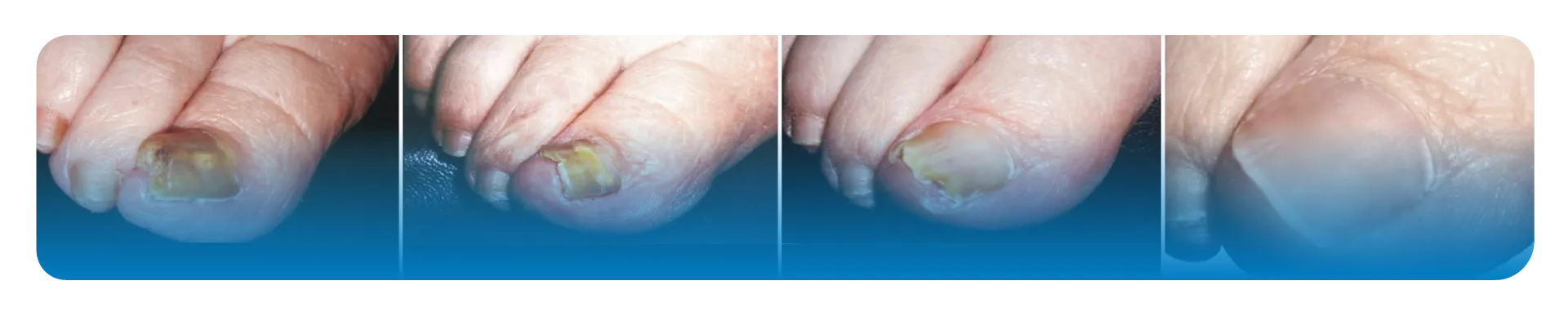 imagen de uñas en proceso de reparación